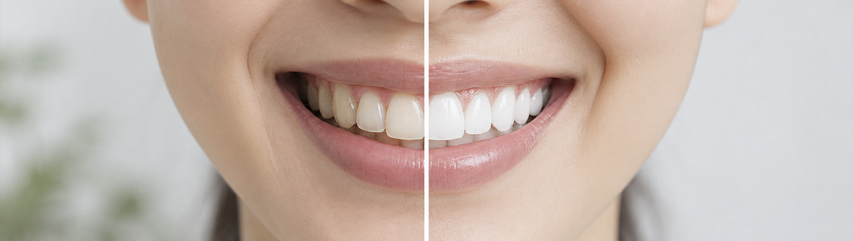 Teeth Whitening